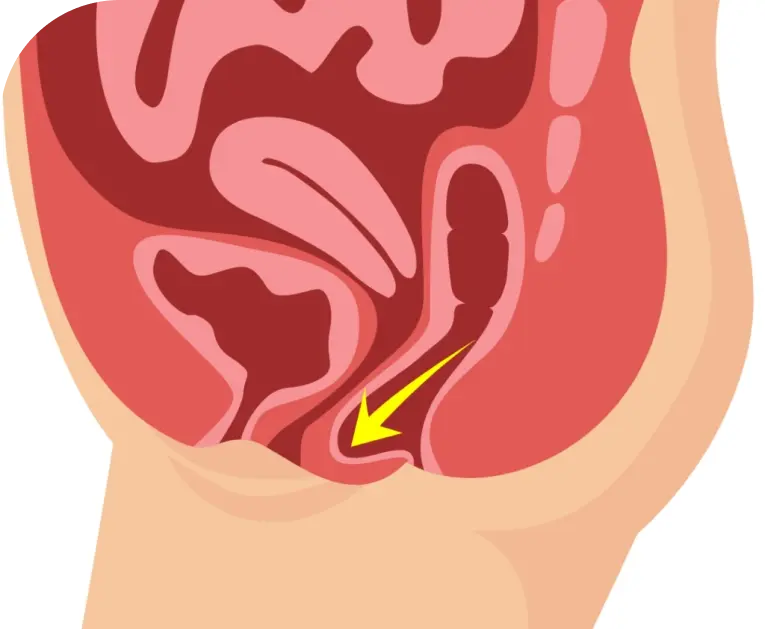 Bowel-Issues-and-Prolapse-1